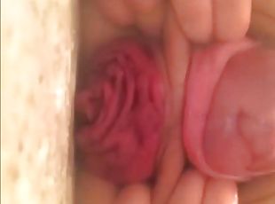 Super cervix prolaps